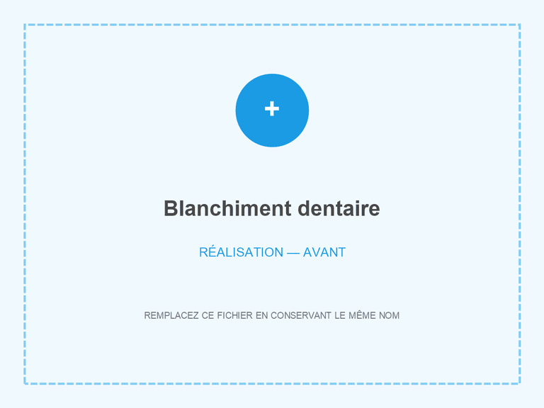 Teinte avant blanchiment dentaire