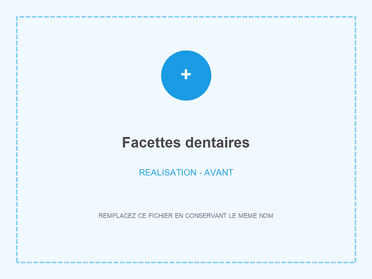 Sourire avant pose de facettes dentaires
