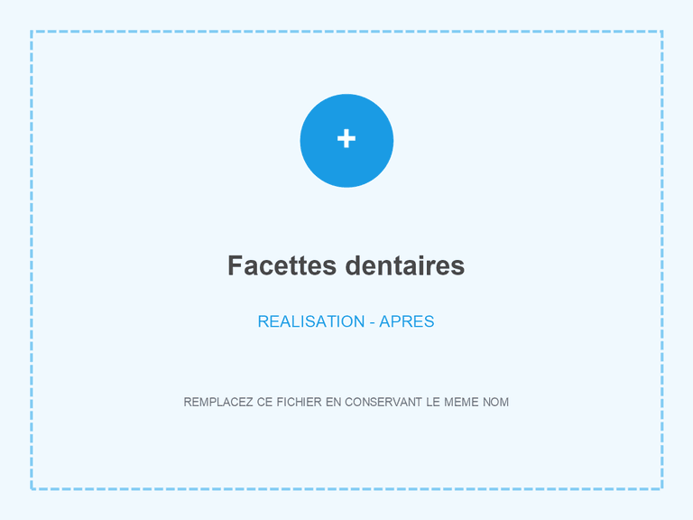 Sourire après pose de facettes dentaires