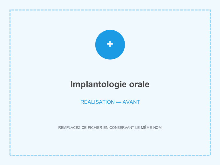 Réalisation clinique avant traitement implantaire