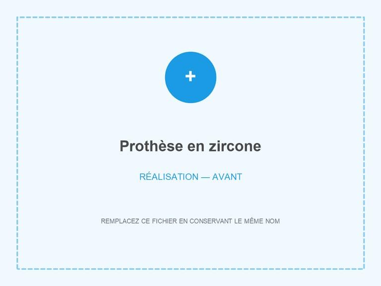 Situation avant pose d’une prothèse en zircone