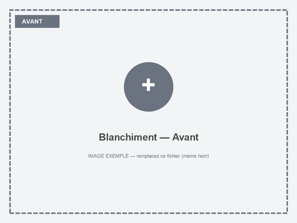 Sourire avant blanchiment dentaire