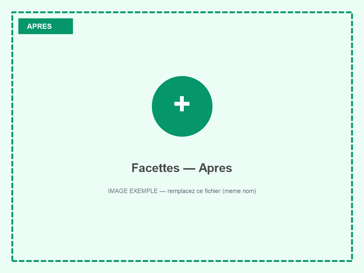 Sourire après pose de facettes